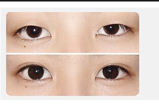 割<a href=http://www.mx185.com/listinfo-724-0.html target=_blank class=infotextkey>双眼皮</a>有年龄限制吗
