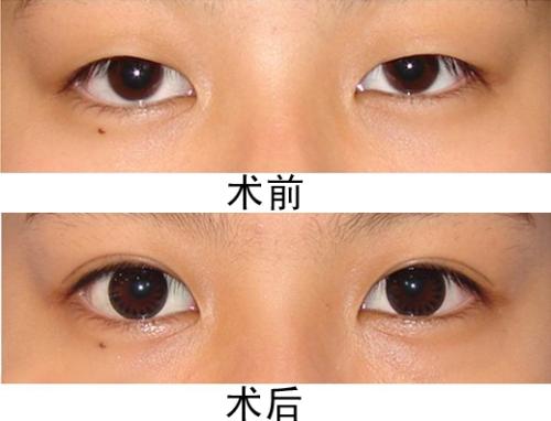 割<a href=http://www.mx185.com/listinfo-724-0.html target=_blank class=infotextkey>双眼皮</a><a href=http://www.mx185.com/listinfo-711-0.html target=_blank class=infotextkey>开眼角</a>多少钱 割<a href=http://www.mx185.com/listinfo-724-0.html target=_blank class=infotextkey>双眼皮</a><a href=http://www.mx185.com/listinfo-711-0.html target=_blank class=infotextkey>开眼角</a>费用