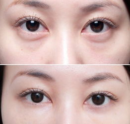 切除眼袋有什么副作用