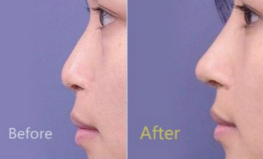 透明质酸<a href=http://www.mx185.com/listinfo-737-0.html target=_blank class=infotextkey>隆鼻</a>变宽能怎么办