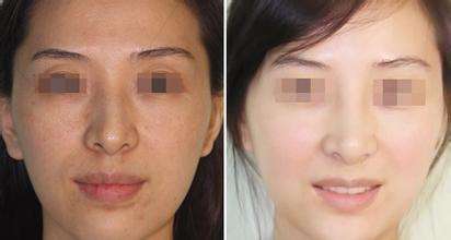 光子<a href=http://www.mx185.com/listinfo-763-0.html target=_blank class=infotextkey><a href=http://www.mx185.com/listinfo-770-0.html target=_blank class=infotextkey>嫩肤</a>美白</a>价格