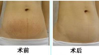 剖腹产疤痕修复方法有哪些