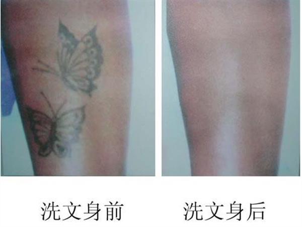激光<a href=http://www.mx185.com/listinfo-793-0.html target=_blank class=infotextkey>洗纹身</a>能用麻药吗