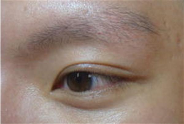 激光洗眉多久可以纹眉