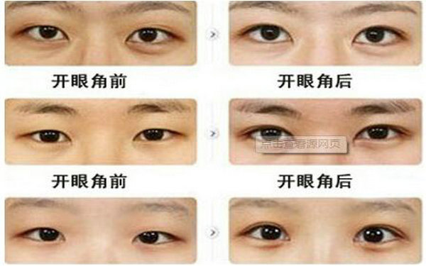 哪种眼睛适合<a href=http://www.mx185.com/listinfo-711-0.html target=_blank class=infotextkey>开眼角</a>?