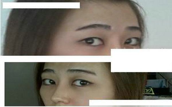 内眼角多久才能做修复?