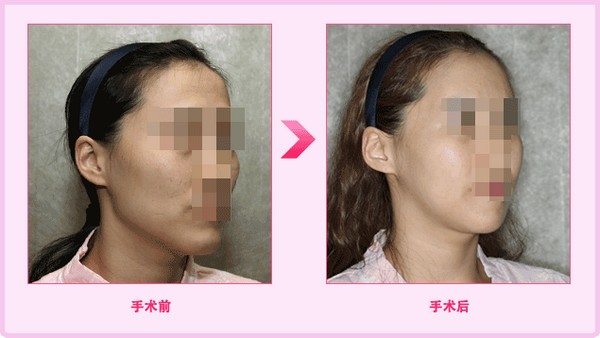 脸两侧骨头突出怎么办