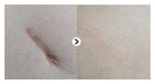 凹陷性疤痕的治疗方法是什么？