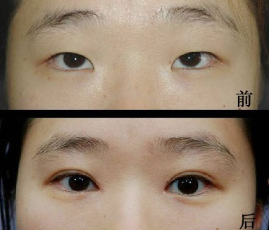 埋线<a href=http://www.mx185.com/listinfo-724-0.html target=_blank class=infotextkey>双眼皮</a>需要拆线吗