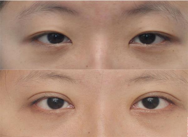 做个<a href=http://www.mx185.com/listinfo-711-0.html target=_blank class=infotextkey>开眼角</a><a href=http://www.mx185.com/listinfo-724-0.html target=_blank class=infotextkey>双眼皮</a>多少钱