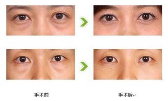 <a href=http://www.mx185.com/listinfo-708-0.html target=_blank class=infotextkey>去眼袋</a>的缺点