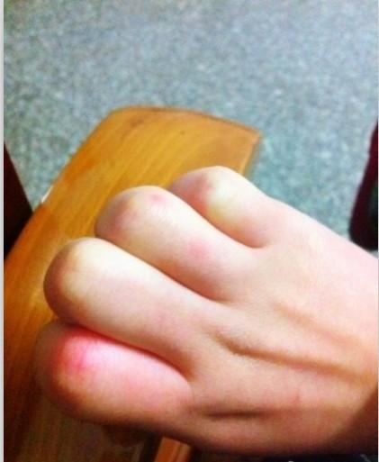 冻伤疤痕修复快的方法
