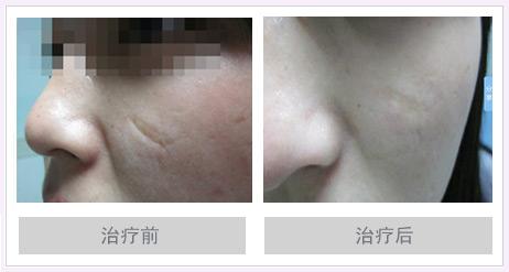 五种脸部疤痕修复办法