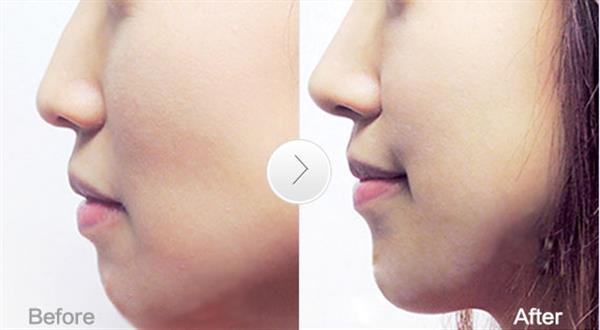 长期打透明质酸<a href=http://www.mx185.com/listinfo-737-0.html target=_blank class=infotextkey>隆鼻</a>好吗