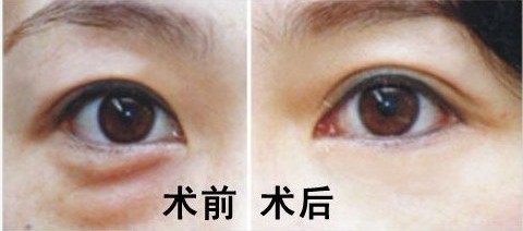 眼袋一旦形成能消除吗