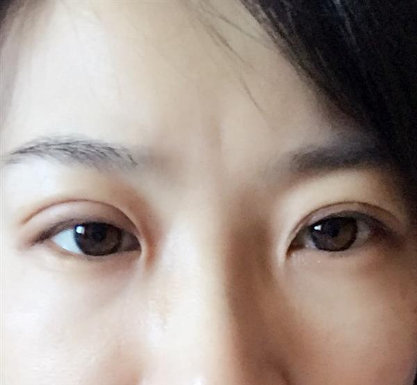 割了双眼皮多久能纹眉吗