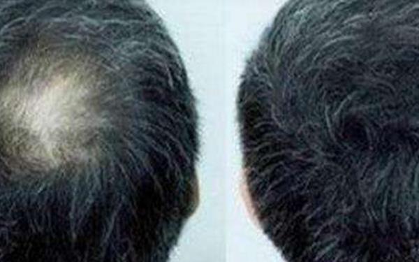 头发种植是长期的吗