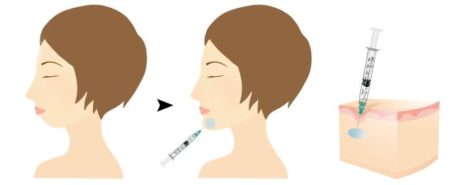 打下巴一般多少钱