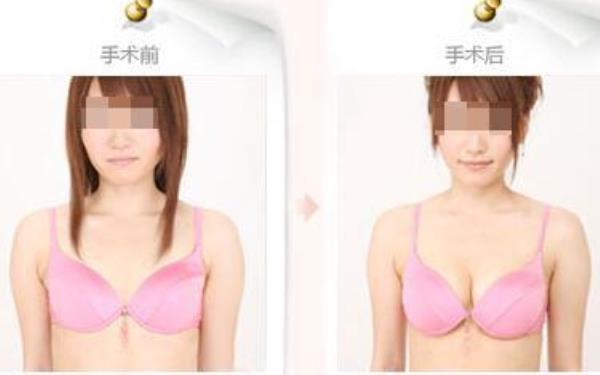 注射丰胸大概多少钱