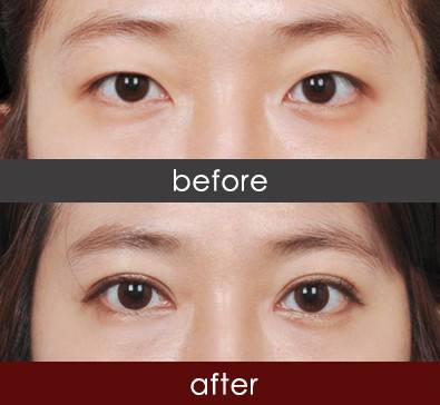 埋线<a href=http://www.mx185.com/listinfo-724-0.html target=_blank class=infotextkey>双眼皮</a>真的没有危害吗