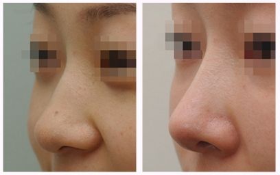 耳软骨垫<a href=http://www.mx185.com/listinfo-757-0.html target=_blank class=infotextkey>鼻尖</a>多少钱