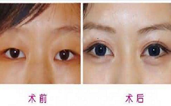 <a href=http://www.mx185.com/listinfo-724-0.html target=_blank class=infotextkey>双眼皮</a>埋线的坏处
