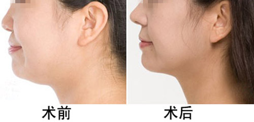 打<a href=http://www.mx185.com/listinfo-631-0.html target=_blank class=infotextkey>瘦脸</a><a href=http://www.mx185.com/listinfo-614-0.html target=_blank class=infotextkey>除皱</a>能吃辣吗