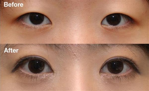 <a href=http://www.mx185.com/listinfo-724-0.html target=_blank class=infotextkey>双眼皮</a>加<a href=http://www.mx185.com/listinfo-711-0.html target=_blank class=infotextkey>开眼角</a>多少钱