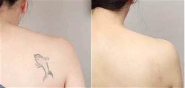 疤痕性皮肤一般可以纹身吗