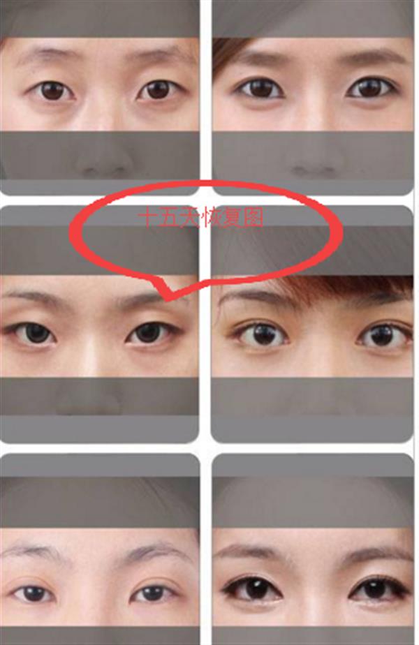 全切<a href=http://www.mx185.com/listinfo-711-0.html target=_blank class=infotextkey>开眼角</a>15天恢复图