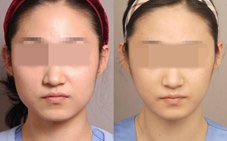 打一次<a href=http://www.mx185.com/listinfo-631-0.html target=_blank class=infotextkey>瘦脸</a><a href=http://www.mx185.com/listinfo-614-0.html target=_blank class=infotextkey>除皱</a>要多少钱