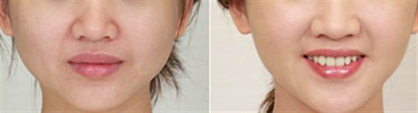 人很<a href=http://www.mx185.com/listinfo-631-0.html target=_blank class=infotextkey>瘦脸</a>很胖怎么办