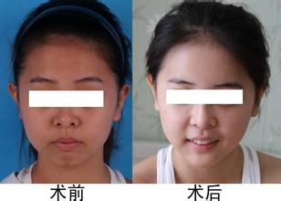 光子<a href=http://www.mx185.com/listinfo-770-0.html target=_blank class=infotextkey>嫩肤</a>后的注意事项