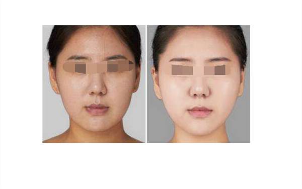 广州彩光<a href=http://www.mx185.com/listinfo-763-0.html target=_blank class=infotextkey><a href=http://www.mx185.com/listinfo-770-0.html target=_blank class=infotextkey>嫩肤</a>美白</a>后的护理要注意什么