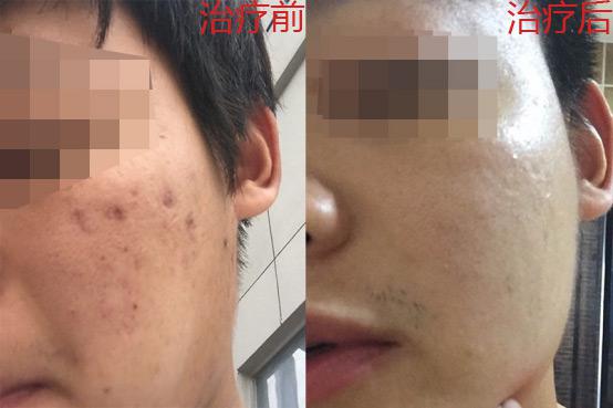 痘疤痘坑要怎么修复