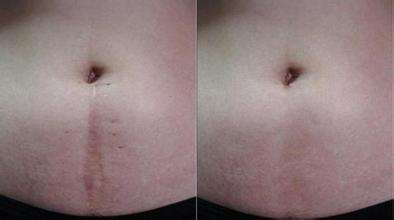 激光<a href=http://www.mx185.com/listinfo-783-0.html target=_blank class=infotextkey>祛疤</a>好吗