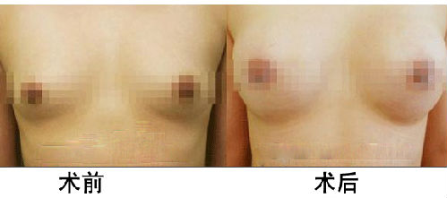 长沙假体<a href=http://www.mx185.com/listinfo-618-0.html target=_blank class=infotextkey>隆胸</a>价格