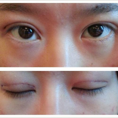 <a href=http://www.mx185.com/listinfo-724-0.html target=_blank class=infotextkey>双眼皮</a>埋线图片