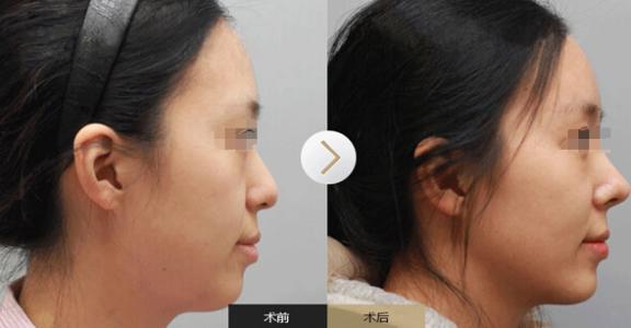 透明质酸的<a href=http://www.mx185.com/listinfo-737-0.html target=_blank class=infotextkey>隆鼻</a>效果是否自然
