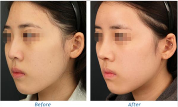 自体软骨<a href=http://www.mx185.com/listinfo-737-0.html target=_blank class=infotextkey>隆鼻</a>价位