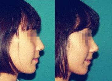 自体软骨<a href=http://www.mx185.com/listinfo-737-0.html target=_blank class=infotextkey>隆鼻</a>什么价位