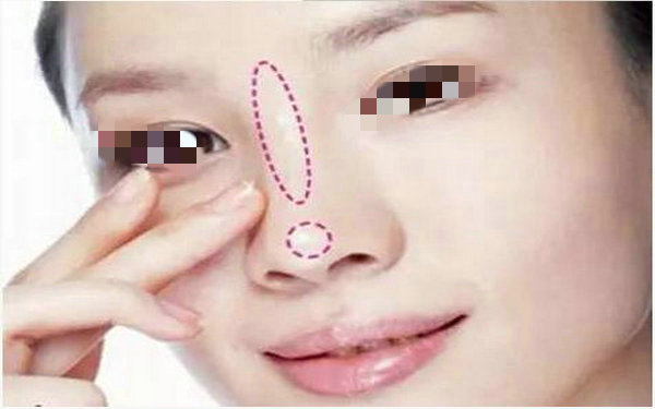 自体软骨<a href=http://www.mx185.com/listinfo-737-0.html target=_blank class=infotextkey>隆鼻</a>多久恢复?