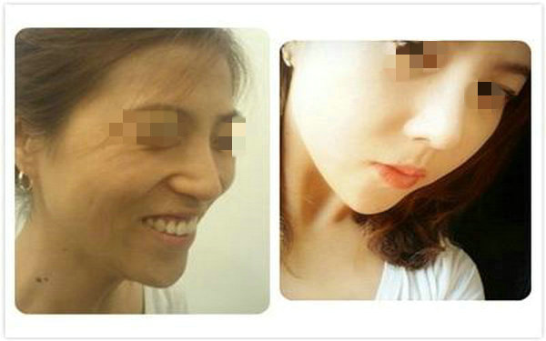 做透明质酸<a href=http://www.mx185.com/listinfo-737-0.html target=_blank class=infotextkey>隆鼻</a>注意事项？