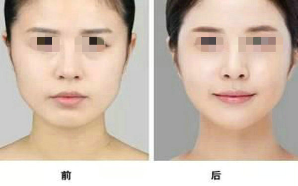注射<a href=http://www.mx185.com/listinfo-737-0.html target=_blank class=infotextkey>隆鼻</a>有什么坏处？