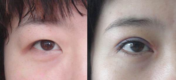 <a href=http://www.mx185.com/listinfo-711-0.html target=_blank class=infotextkey>开眼角</a>有什么后遗症吗