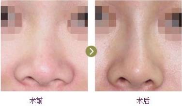 <a href=http://www.mx185.com/listinfo-754-0.html target=_blank class=infotextkey>鼻翼</a>缩小手术做了后悔怎么办