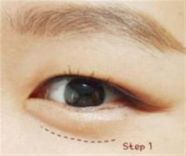 透明质酸注射<a href=http://www.mx185.com/listinfo-722-0.html target=_blank class=infotextkey>卧蚕</a>多少钱