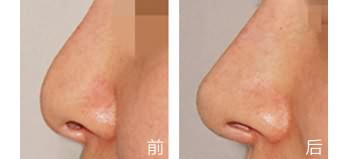 如何通过手术缩小鼻翼