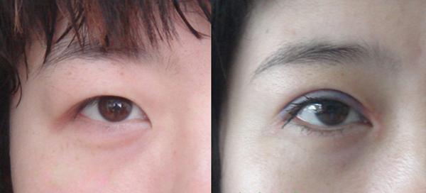 <a href=http://www.mx185.com/listinfo-711-0.html target=_blank class=infotextkey>开眼角</a>图片前后对比
