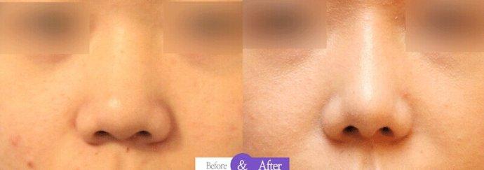 <a href=http://www.mx185.com/listinfo-751-0.html target=_blank class=infotextkey>歪鼻矫正</a>术的手术方法有哪些